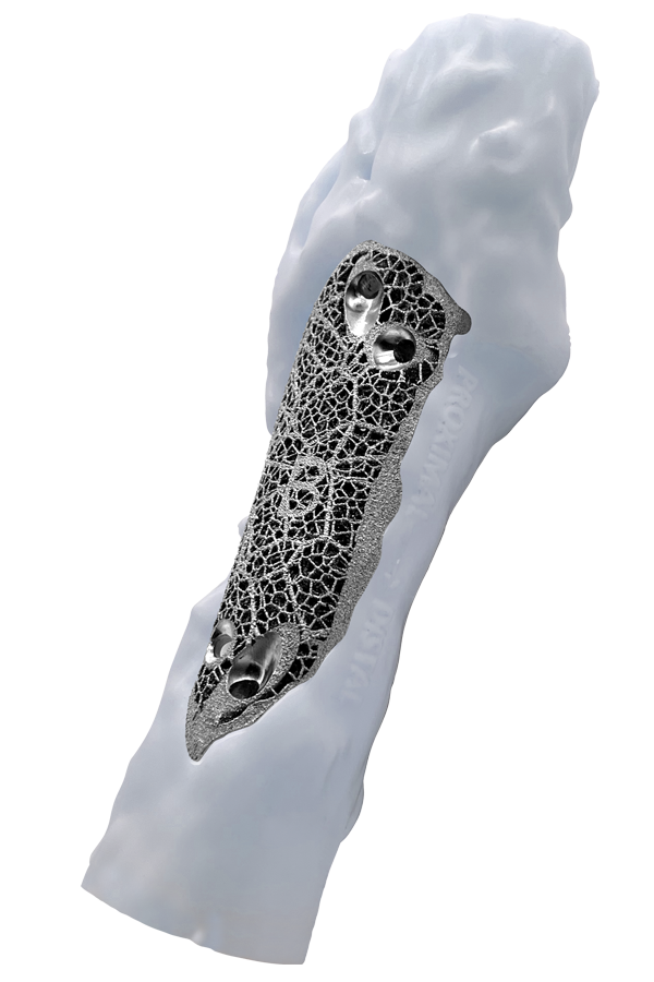 Oncology titanium mesh implant